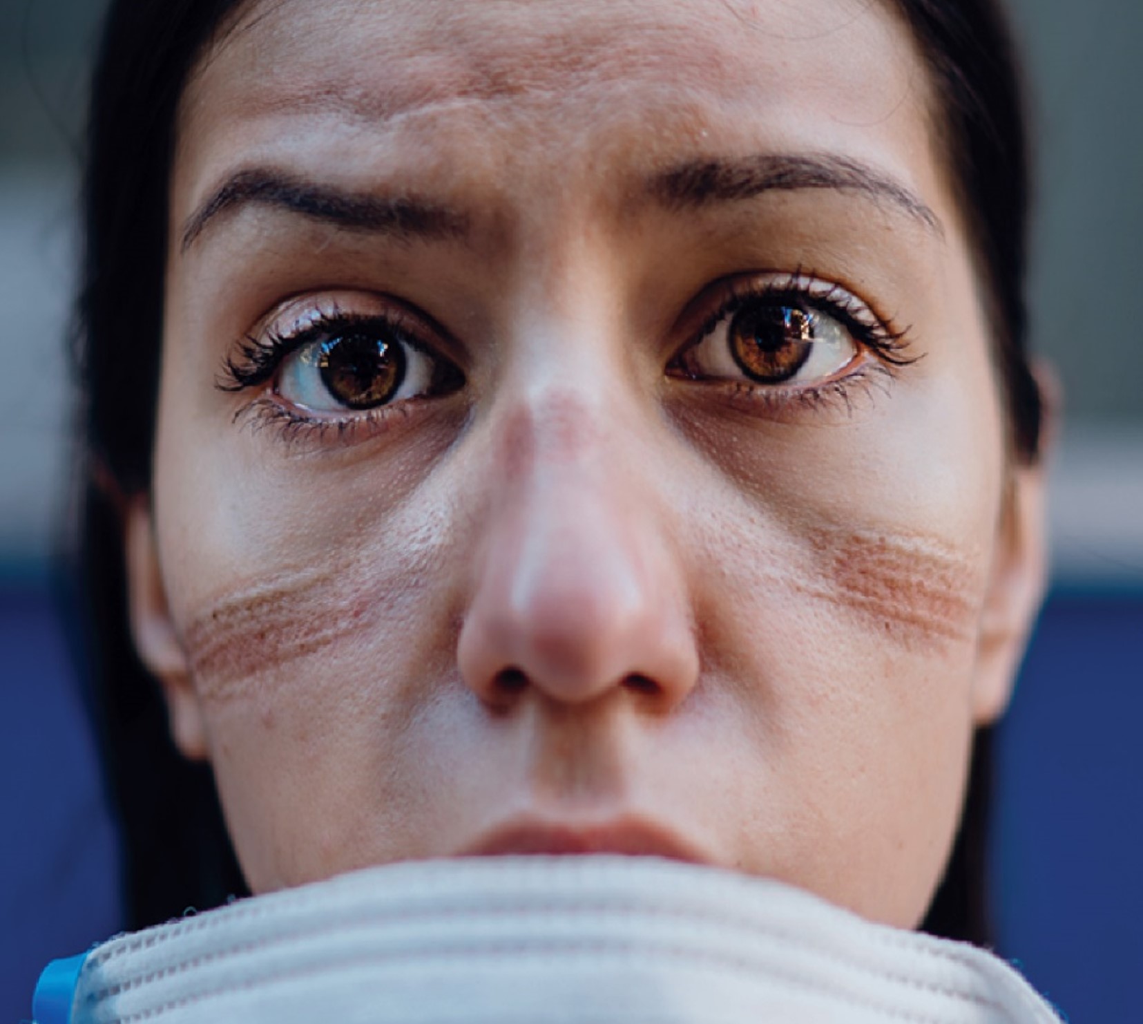 Nurse with mask scars on her face.