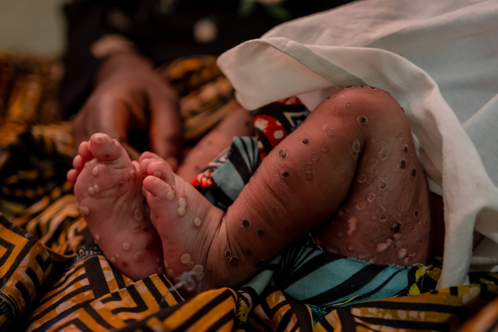 A 3-week-old girl suffering from mpox in the emergency room at Kavumu Hospital in South Kivu, Democratic Republic of the Congo