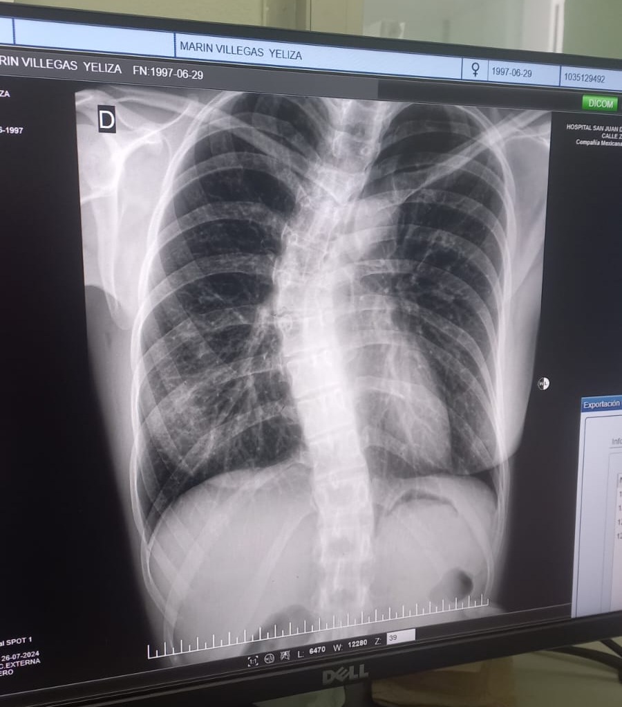 Radiography of the spinal cord