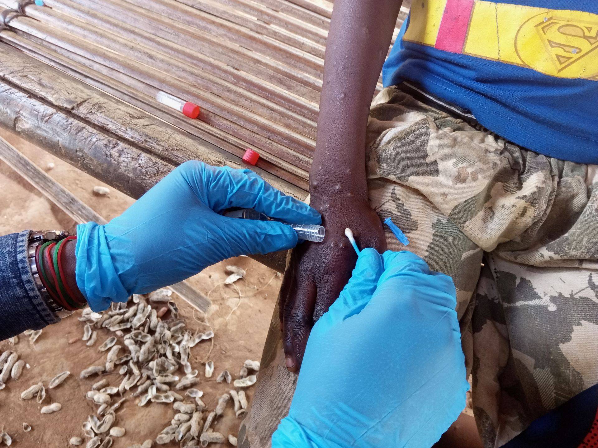 taking sample from person with mpox Sample being taken from a person with mpox