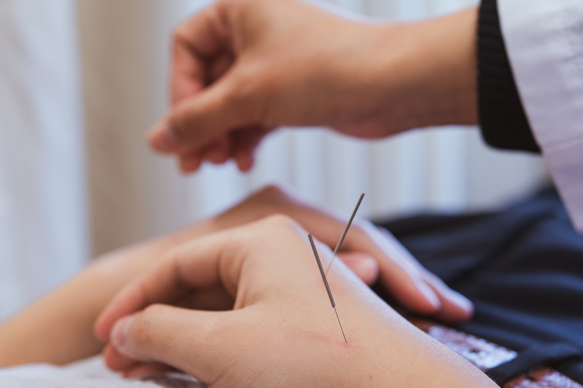 A hand pricking acupuncture needles into a patient's hand