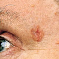 Basal cell carcinoma