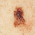Malignant melanoma